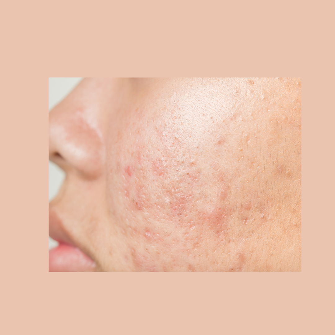 От комедони до комедогенен индекс: как да изберем правилната козметика за нашата кожа?